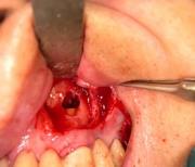Cirugia Periapical